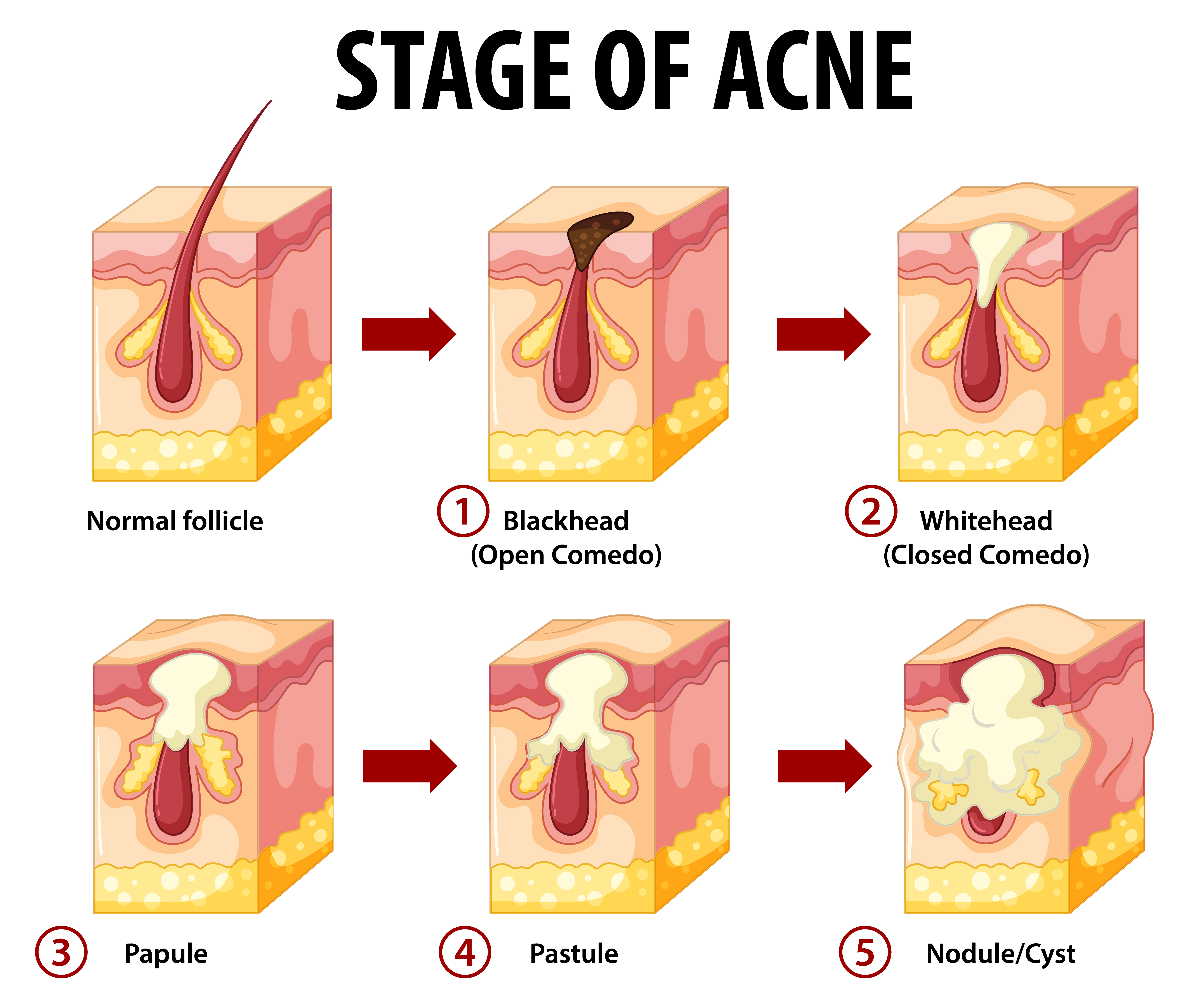 To 🌱 of rid scalp get acne how Pimples On